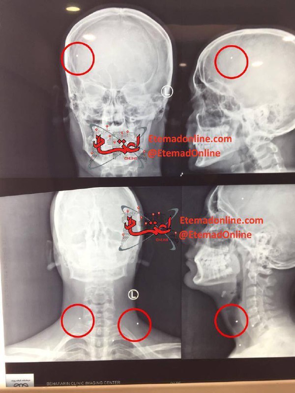 درباره این مقاله بیشتر بخوانید 📸 تصاویری از ساچمه‌های موجود در بدن امیرحسین رحیمی