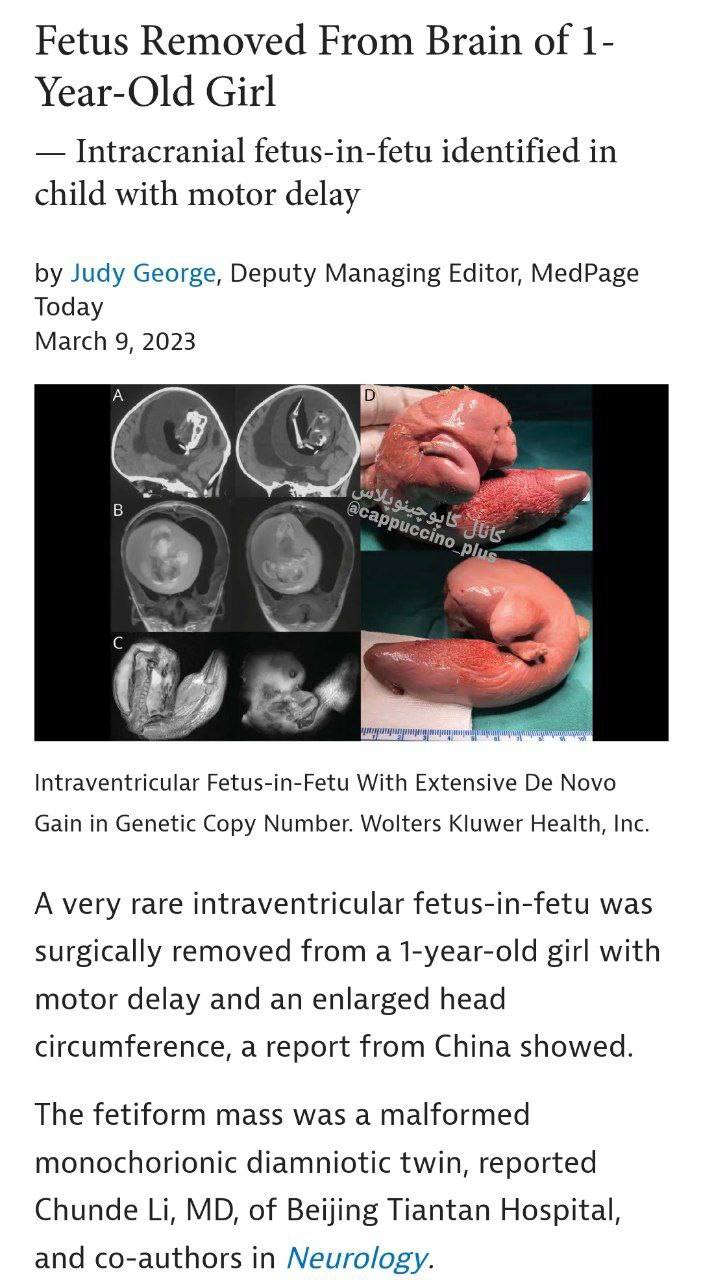 درباره این مقاله بیشتر بخوانید جنین دو قلو از سر یک دختر بچه یک ساله خارج شد.
