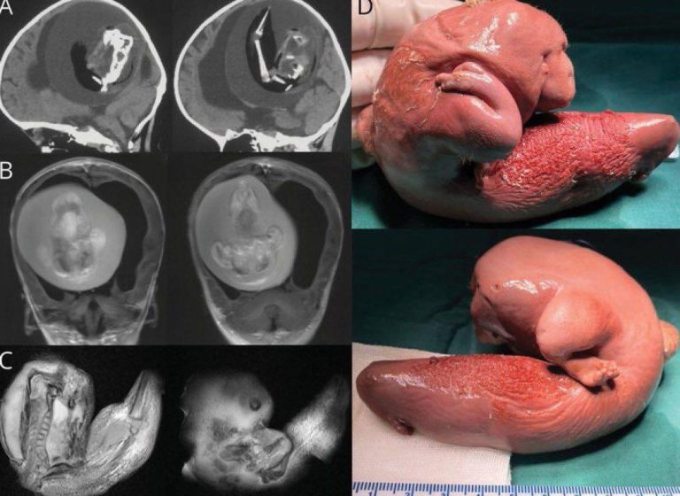 درباره این مقاله بیشتر بخوانید خروج یک جنین مرده از سر بچه ۱ ساله!