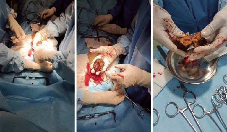 درباره این مقاله بیشتر بخوانید 🔵 توده عجیب خرمالو در معده چند بیمار